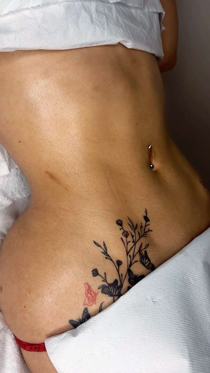 Lymphatic drainage after liposuction is a therapeutic massage technique designed to encourage the natural drainage of lymph, a fluid that helps remove waste and toxins from the body. Liposuction can disrupt the lymphatic system, leading to fluid retention, swelling, and discomfort. Lymphatic drainage massage helps promote healing, reduce swelling, and enhance recovery.
Key Benefits of Lymphatic Drainage After Liposuction:
1. Reduces Swelling: Helps reduce post-surgical swelling by moving excess fluid away from the treated area.
2. Prevents Lumps and Bumps: Liposuction can cause fluid pockets that result in irregularities; lymphatic drainage smooths these areas out.
3. Improves Healing: By promoting better circulation, it can speed up the healing process and reduce inflammation.
4. Pain Relief: Reducing fluid retention can alleviate post-surgical pain and discomfort.
5. Reduces Bruising: It helps flush out trapped blood and toxins, minimizing bruising.
Timing and Frequency:
- When to Start: Typically, lymphatic drainage is recommended to begin within the first week after surgery, but always consult with your surgeon.
- How Often: Multiple sessions are often recommended, starting with 2–3 times per week during the first few weeks, then reducing the frequency as swelling and fluid retention decrease.
#bbl #lipo #lymphaticdrainage #lymphaticdrainagemassage