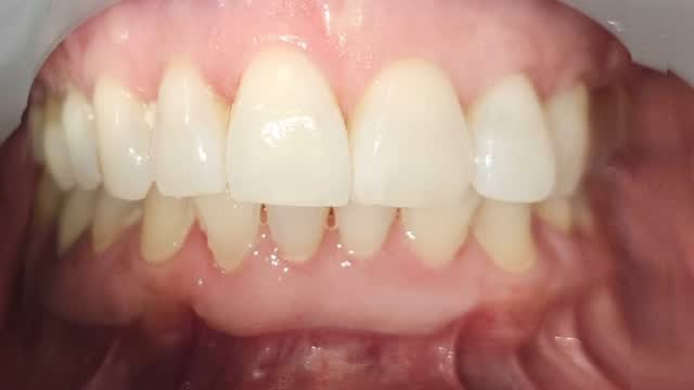 ✨ Straighter teeth without anyone noticing? Yes, please.
Our clear aligners fit your lifestyle. Whether you’re heading to class, work, or chasing kiddos.
#SmileOnYourTerms #RothbauerDental #LakewoodWA #ClearAligners #BusyLife