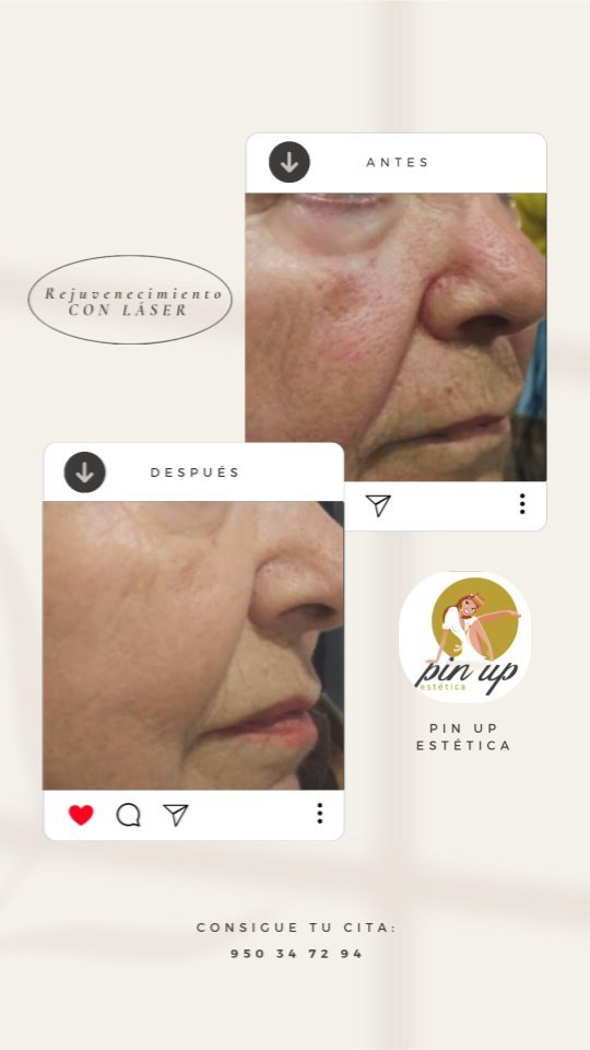 ✨Descubre el poder de una piel renovada con el rejuvenecimiento facial con láser✨
Este tratamiento avanzado elimina arrugas, manchas y cicatrices, devolviéndole a tu piel su frescura y luminosidad. Sin cirugías y con un mínimo de recuperación, verás resultados naturales y duraderos gracias a la estimulación de colágeno. ¡Ven y deja que nuestra tecnología láser realce tu belleza natural!
Pide tu cita ya al 950 347 294
📍 Avenida Carlos III, 216
Aguadulce, Almería
#dermapen #laser #fotorejuvenecimiento #aguadulce
#almeria