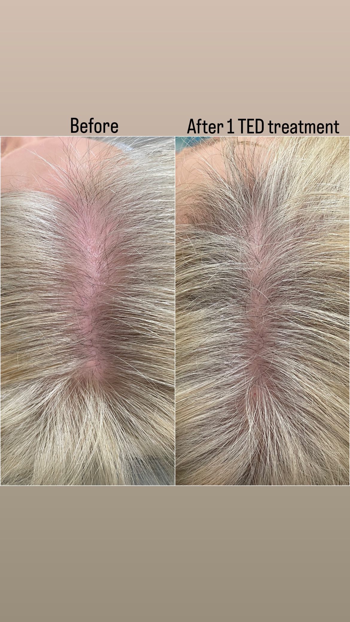This client said she definitely noticed less shedding after her first TED treatment, but the new growth though ๐
This is 4 weeks after her first TED treatment.
Canโt wait to see the growth after the next few sessions!
August is #hairlossawarenessmonth and if youโve been dealing with thinning hair, now is the time to reverse it and get those luscious locks back before the holidays!
Initial treatment options start with a minimum of 3 treatments, but we have multiple different packages available.
Links to booking AND our payment plans in bio!
#hairlosstreatment #hairlossawareness #hairrestoration #zionsvillemoms #zionsvillehair #tedhairrestoration #almated #ted