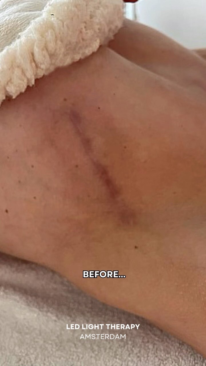 Tired of scars? Discover the power of LED light therapy. โจ Say goodbye to acne and surgery scars with our non-invasive treatment. Book your session today!
#ledlighttherapy #scars #skincare #transformation #holisticwellness #amsterdam #selfcare #relaxation #stressrelief #mindfulness #breathwork #healing #lesublimewellness #emotionalhealing #breastscar #naturalbeauty #holisticbeauty #ConfidenceBoost #wellness #beauty #betteraging #ledlighttherapyamsterdam #beautysalon #beautytips #autumnskin #winterglow #antiaging #collagenboost #skinrejuvenation #acne
