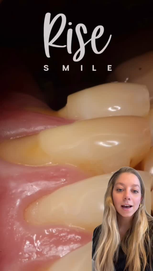 #saluddental #dentalcare #dental #lcnc