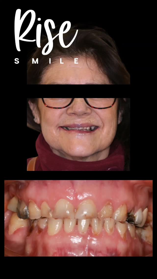 Mira este caso de Rehabilitacion Oral integral
La paciente nos consulta por el gran desgaste dentario, que le estaba produciendo un problema estético.
Realizamos una planificacion de tratamiento que consistió en el aumento de la altura de sus dientes lo que no solo mejora la estética dentaria, sino que tiene un impacto en la estética facial tal como podemos ver en el antes y después.