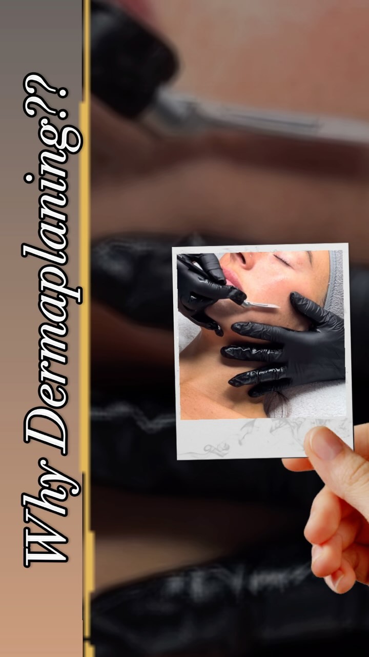 Revealing that fresh skin after Dermaplaning is what makes our results so amazing!! 💫
Recommend for skin rejuvenation, Aging skin, Dull, tired skin and Uneven skin tone
Whether it’s just a Dermaplane stand alone treatment or combined with another treatment where Dermaplaning plays a vital part in the protocol ✅
Removing the build up of dead skin and peach fuzz will give you that smooth finish and make up will glide on effortlessly leaving you with freshly glowing skin! 🥰
Dermaplaning increases the absorption rates of all topical products applied to the skin following your treatment 💦
#exfoliate #skin #skincare #refresh #rejuvenation #glowingskin #hydration #selflove #treatment