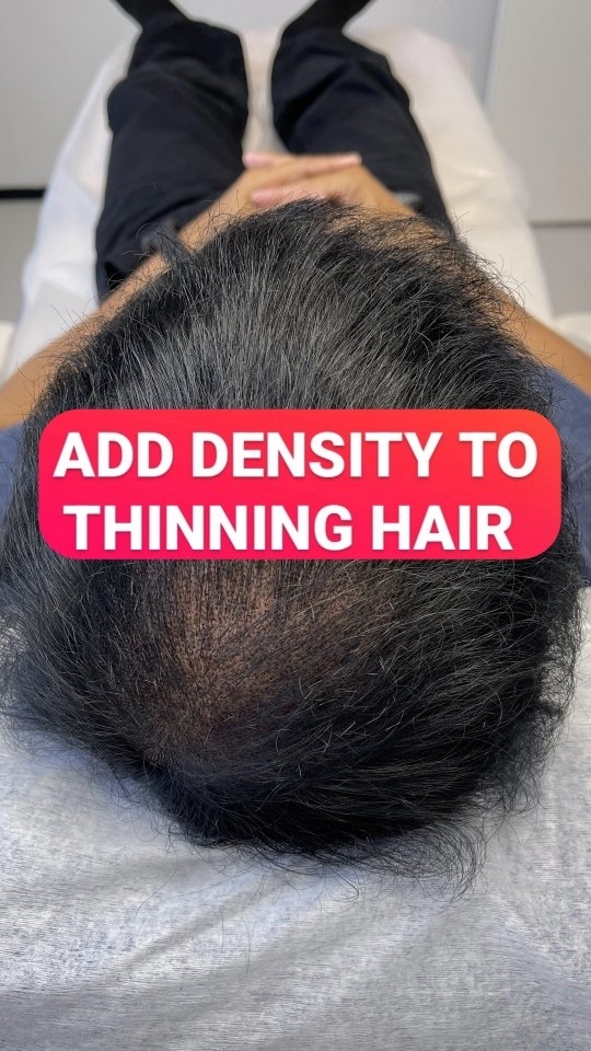 Struggling from thinning hair? Want to get an illusion of thicker hair just in 2-3 sessions?
With SMP, I can help add density to your thinning hair.
During SMP, inserted tiny dots of pigment replicates hair follicles on your head. And as a result, your hair seems denser, thicker and fuller. Isn't it great?!
🗓 Book a free consultation to get:
- answers to all your questions,
- an individual plan of SMP for your type of hair-loss, 
- price for your case.
🗣We speak EN, FI, RU. Feel free to get in touch any time:
- DM me here, in Instagram 
- text me in WhatsApp +358409681999
- or book a free consultation via my website – the link is in the bio.
My certified professional studio of Scalp MicroPigmentation is located in: 
Niittaajankatu 9, 00810 Helsinki, Finland 🇫🇮
Follow @scalp.fi for more transformational insights about hair-loss solutions.