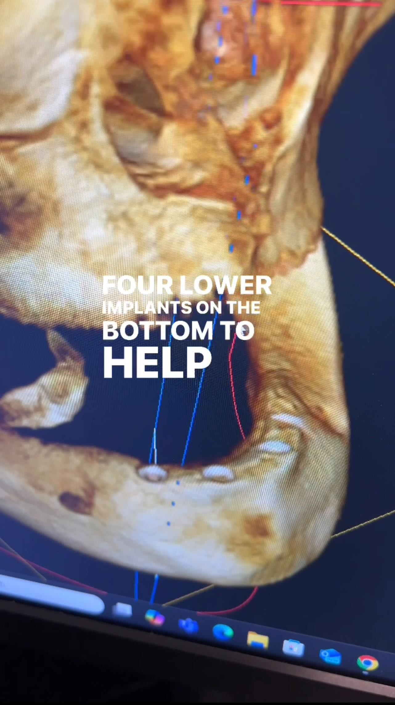 “Snap-in dentures” or overdentures are a great alternative treatment to “All on X” or fixed dentures. You can enjoy the foods you love again at a fraction of the cost. And best of all you never have to use any denture glue to help hold your denture in! #conwaydentist #orlandoimplants #dentalimplants