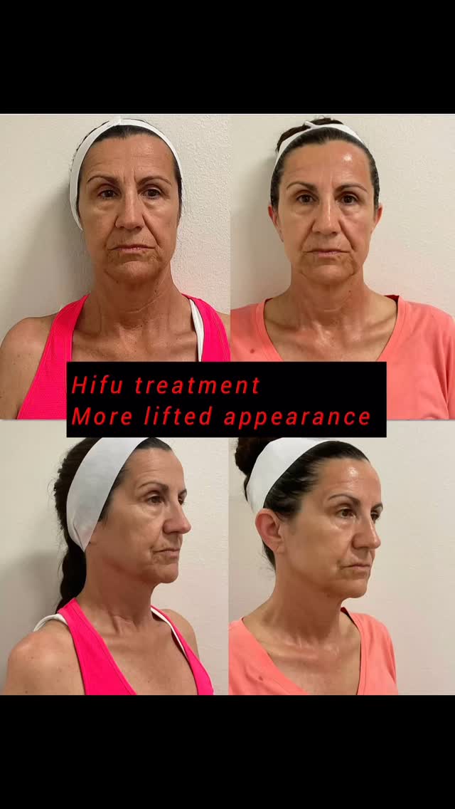 HIFU (High-Intensity Focused Ultrasound) offers several benefits for skin tightening and facial rejuvenation, including reducing wrinkles, tightening sagging skin, and enhancing jawline definition
#capricebeautybar #theskingames2024 #age #tampabay #sarasotaflorida #sarasota #hifu #hifufacelifting #miami #verobeachflorida #stpetersburgflorida #fruitville #medspa