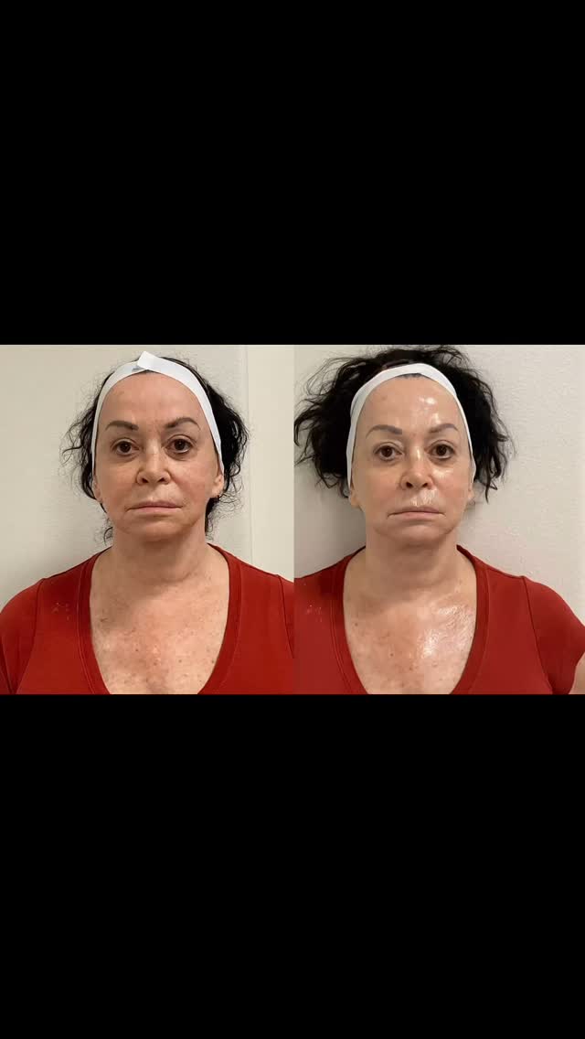 Other great Hifu lift ‼️
Can’t wait more improvement few months 😃#capricebeautybar #age #age #tampabay #medspa #sarasotaflorida #sarasota #skin #hifufacelifting #hifu #sarasotawomanowned #skinrejuvenation