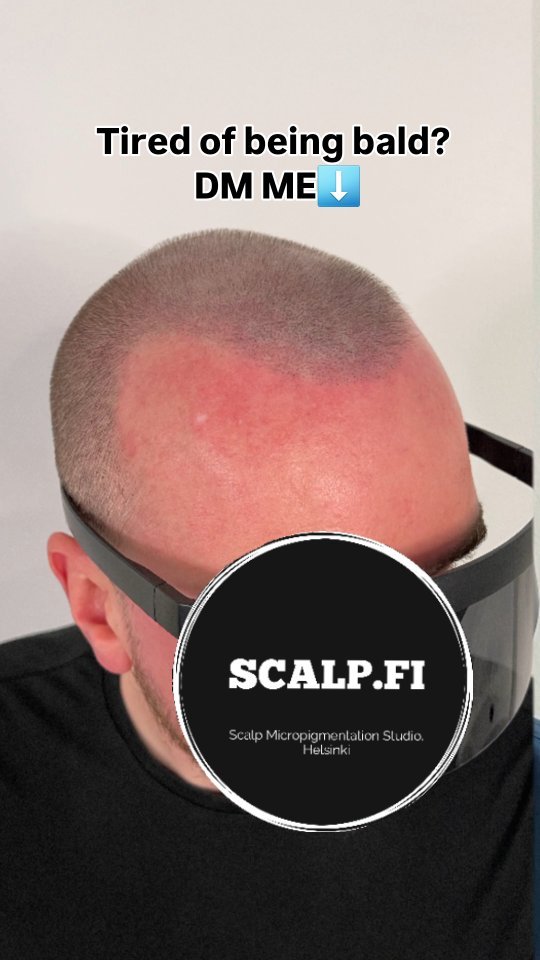 You don't have to be bald if you don't want to!🔥
In 2024, there is a safe and natural-looking solution to hair-loss– Scalp MicroPigmentation.
🗓 Book a free initial consultation to get:
- answers to all your questions,
- an individual plan of SMP for your type of hair-loss, 
- price for your case.
🗣We speak EN, FI, RU. Feel free to get in touch any time:
- DM me here, in Instagram 
- text me in WhatsApp +358409681999
- or book a free consultation via my website – the link is in the bio
My certified professional studio of Scalp MicroPigmentation is located in: 
Niittaajankatu 9, 00810 Helsinki, Finland 🇫🇮
Follow @scalp.fi for more transformational insights about hair-loss solutions.
#scalpmicropigmentation #scalptattoo #hairtattoo #tricopigmentation #hairlinetattoo #трихопигментация #balding #hairloss #micropigmentation #microshading
