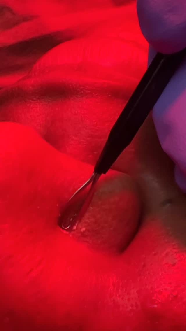 As we hit our 30s, our skin’s needs change. Facials can be a game-changer! They help address concerns like fine lines, wrinkles, and loss of radiance. A good facial can deep clean pores, boost collagen production, and leave skin looking smoother and brighter. Regular facials can also help with hyperpigmentation, acne, and skin texture. Plus, it’s a great way to relax and unwind. By investing in facials, you’re investing in your skin’s health and appearance. Your skin will thank you! Whether you’re dealing with specific skin concerns or just want to glow, facials are worth considering. #Facials #SkinOver30 #detmaplanning #microneedling #hifu #lymphaticdrainage #skincare #facial #kemskin #kemskintotalbeauty #esthetician