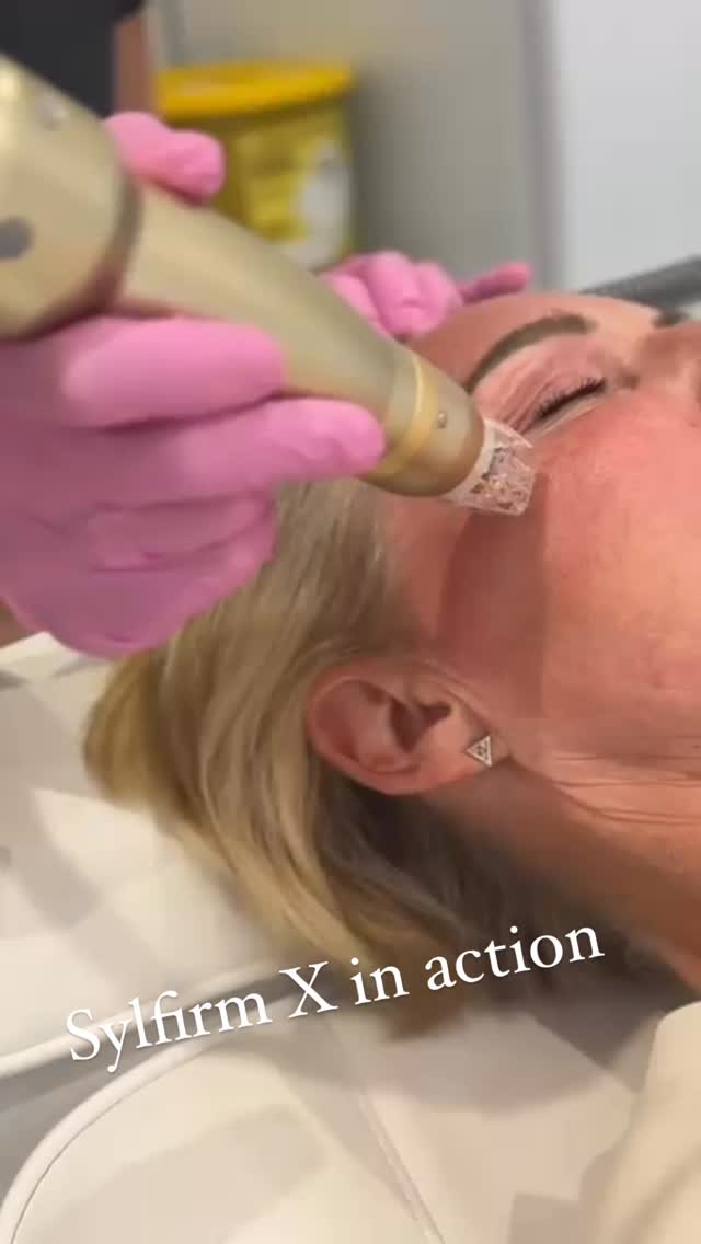 ✨ Pores? Who are they?
Wrinkles? Never met her.
Redness? Ghosted. 👻
Say hello to Sylfirm X – the overachiever of skin treatments. 🎯 Combining microneedling with radiofrequency (because your skin deserves a power couple), this next-gen device targets fine lines, tightens saggy skin, acne scars, redness, AND lifts while it’s at it. 💪
Basically, it’s like therapy for your skin—with better results and less crying. 😉💉
#SkinGoals #SylfirmX #GlowUpSeason #MicroneedlingMagic #CollagenQueen #RFpower #SkinReboot