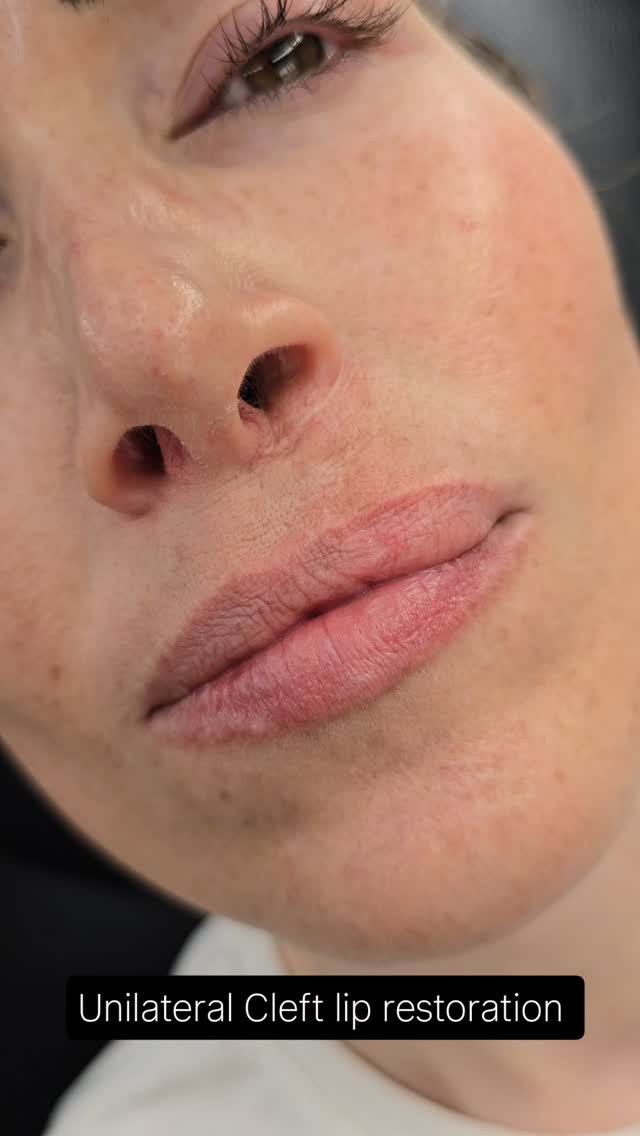 It's more than just permanent makeup 🖤🫶🏽
This beautiful soul was born with a unilateral cleft lip and has undergone many surgeries. Despite her confidence, she still battles insecurities. Our aim was to create a natural lip shape, not just a lipstick look! I believe it was accomplished 🪄
Restoration lip blushing can help with;
- Sun Damaged Lips
- Cleft Lips
- Scars
- Dog Bites
- Freckles ... and more!
Dm or Text (843)499-4357 to schedule your appointment!
www.charlestonpermanentmakeup.com
#lipblush #lipblushtattoo #restorativelipblush #lips #browslipseyes #definedlips #paramedicaltattoo #lipblushtraining #charlestonlips #microbladingcharleston #cosmetictattoo #permanentmakeup #permanentmakeupspecialist #southcarolina #Charleston #mtpleasant #summervillesc #ladson #jamesisland #johnsisland #Kiawah