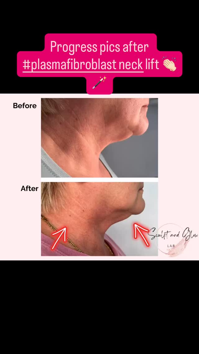 I love some good progress shots 👏🏻🪄
These pictures are taken only 1 week post #plaxpot #plasmafibroblast neck lift treatment. Full results will be visible in another 6ish weeks 😬
I CANNOT believe how much the deep set wrinkles have smoothed out the lax skin has lifted 👏🏻 #excited for the final results
.
#noninvasivenecklift #plaxpotplasma #plasmafibroblastperth #necklift #rejuvenation #skingoals #wrinkletreatment #perthbeauty #bodysculptingspecialistperth #nurseledclinic #sculptandglowlab #realresultsrealpeople #clientjourney