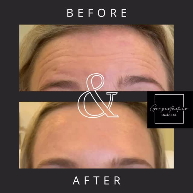 📸B&A
💗We love a natural result!
🌞Are you ready for summer?
•
•
•
Reserve your spot today!
🔝𝓒𝓵𝓲𝓬𝓴 𝓸𝓷 𝓶𝔂 𝓹𝓻𝓸𝓯𝓲𝓵𝓮~𝓽𝓸 𝓫𝓲𝓷𝓰𝓮 𝓶𝓸𝓻𝓮 𝓬𝓸𝓷𝓽𝓮𝓷𝓽 ♥️
𝓟𝓻𝓲𝓬𝓲𝓷𝓰 𝓪𝓷𝓭 𝓢𝓮𝓻𝓿𝓲𝓬𝓮𝓼 𝓬𝓪𝓷 𝓫𝓮 𝓯𝓸𝓾𝓷𝓭 𝓸𝓷 𝓶𝔂 𝔀𝓮𝓫𝓼𝓲𝓽𝓮.
𝓛𝓲𝓷𝓴 𝓲𝓷 𝓑𝓲𝓸⬆️
👩🏻⚕️Trudy DiFranco RPN
📍Burlington, Ontario
📲905-975-6788
#botoxburlington
#brotoxburlington
#lipfillerburlington
#cheekfillerburlington
#chinfillerburlington
#jawlinefillerburlington
#dysportburlington
#prpburlington
#microneedlingburlington
#alumiermdburlington
#nasolabialfolds
#marionettelines
#chemicalpeel
#fatdissolving
#cannulalips
#collagenstimulation
#neckfat
#brafat
#lovehandles
#xeominburlington
#vampirefacial
#radiesseburlington
#exosomes
#purasomes
#xeominburlington