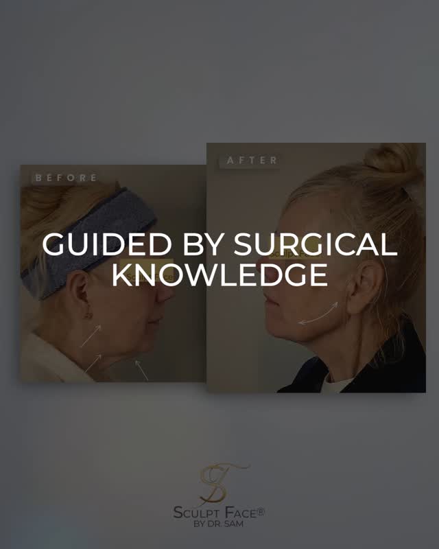 A sculpted jawline.
A lifted neck.
Skin that reflects light naturally.
Restoring structure and redefining contours.
At Sculpt Face®, we don’t just follow trends.
Every result is shaped through the Sculpt Face Protocol™ by Dr. Sam.
Our surgeon-led approach to non-surgical rejuvenation.
#SculptFace
#SculptFaceProtocol
#NoFiller #NoFreeze
#NonSurgicalFacelifts
#SkinRejuvenation
#SkinGoals
#GlowFromWithin
#CollagenBoost
#SkinTightening
#SkinTighteningTreatment
#facialrejuvenation
#laserrejuvenation
#nonsurgical
#aesthetictreatments
#liverpoolaesthetics
#manchesteraesthetics
#greatermanchesteraesthetics
#cheshireaesthetics