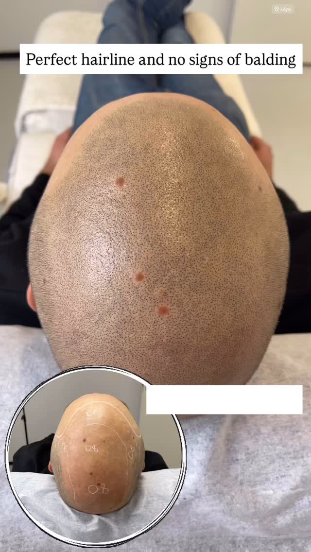 Get to look 5-10 years younger without balding spots 
3 SMP sessions and your bald spots are gone. Get confident about your hair!
You will forget the need to hide your bald crown under the hat.
Feel free to contact me and ask any questions about SMP. 
✅ I am Sergei Shaikhulin, your SMP expert with 4 years of experience. 
🇫🇮 I am the owner of the Certified SMP studio in Helsinki, Finland. 🗣We speak EN, FI, RU.
🗓 Book a FREE initial consultation to get:
- answers to all your questions,
- a plan of SMP for your type of hair-loss, 
- price for your case.
