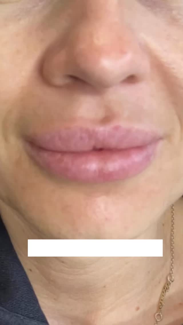Hey, you! 👋
I know you’ve been putting off dissolving that filler you’re no longer happy with. And the reason being - well, it just no longer feels like you…
And that’s ok! Reversing filler is a decision I have seen many people make over the last decade, and fortunately we have the option to with hyaluronic acid based dermal fillers.
“What if my skin is wrinkly or stretched?”
“What if I don’t like my old face?”
“What if I end up overfilled again?”
“I can’t face the world for the next few weeks without any lips!”
All very real. All very valid.
And I’ll be here to support you along the way, because reversing the filler treatment that no longer serves you will likely be the best thing you’ve done for yourself in a while!
And retreating again? Of course it’s an option. We usually wait at least 2-4 weeks before we retreat. And when we do, expect to feel even more like you 💕
#fillerreversal #dermalfillerreversal #lipfillerdissolve #newlipfiller #liptransformation #liprefill #lipfillersessex