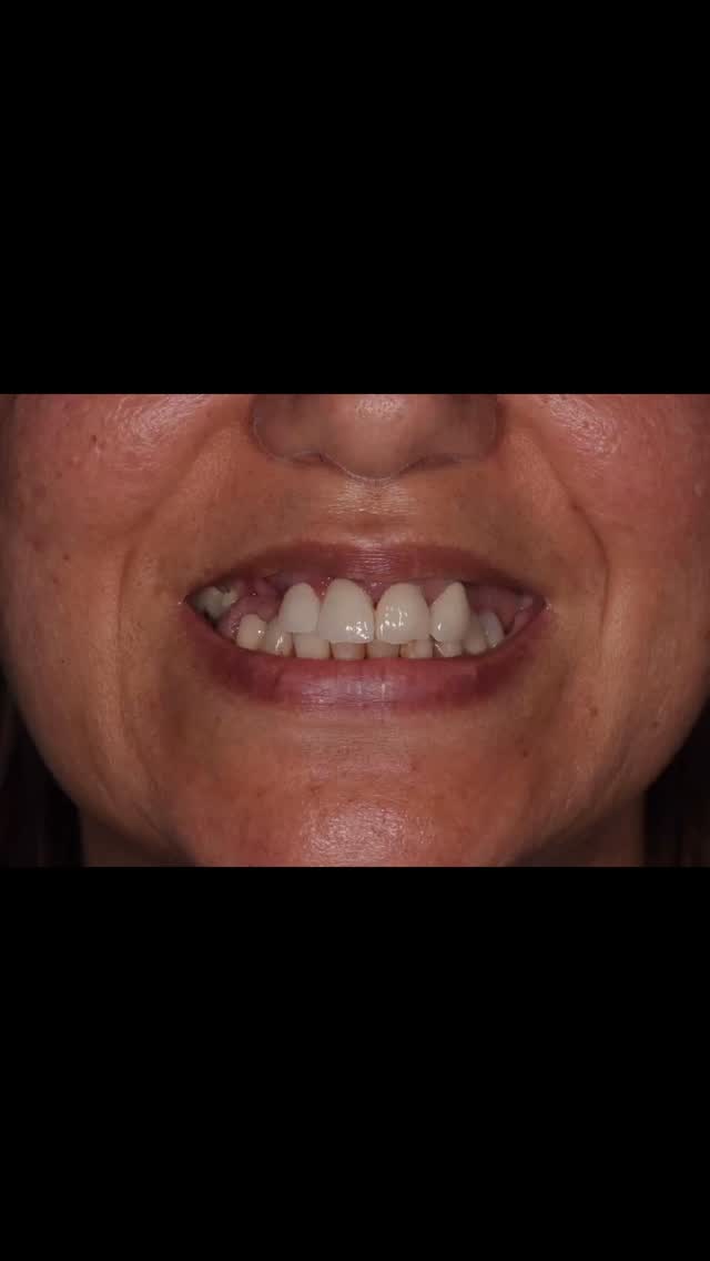 Hoje partilho convosco a sequência clínica e laboratorial de um caso clínico de reabilitação total superior com a técnica All-on-4, realizado com recurso à tecnologia de fotogrametria — uma abordagem inovadora que nos permite alcançar níveis de precisão e conforto verdadeiramente excecionais. 🙌
✅ Vantagens deste sistema digital:
🔹 Captação precisa da posição dos implantes, através da fotogrametria;
🔹 Consultas mais rápidas e eficientes, com menos tempo na cadeira;
🔹 Maior conforto para o paciente, sem necessidade de moldes tradicionais;
🔹 Adaptação protética mais precisa e passiva, com a colocação de próteses impressas.
Esta é uma tecnologia avançada que na nossa prática já faz parte da rotina diária, sempre com o objetivo de oferecer soluções mais eficazes e confortáveis aos nossos pacientes. 💪🦷
Porque cada sorriso merece o melhor da ciência e da medicina dentária.
Trabalho cirúrgico realizado por @mariananunes.md
Trabalho laboratorial realizado por @ana__cattarina @damaso.monica
moniqa_bernardo
—————————————————————————————
Today I’m sharing the clinical and laboratory sequence of a full upper rehabilitation using the All-on-4 technique, performed with photogrammetry technology — an innovative approach that allows us to achieve truly exceptional levels of precision and patient comfort. 🙌
✅ Advantages of this digital system:
🔹 Highly accurate capture of implant positions through photogrammetry;
🔹 Faster and more efficient appointments, with less time in the chair;
🔹 Greater comfort for the patient — no need for traditional impressions;
🔹 More precise and passive prosthetic fit, with 3D-printed prostheses.
This is advanced technology that has already become part of our daily routine, always with the goal of offering more effective and comfortable solutions to our patients. 💪🦷
Because every smile deserves the very best of science and dentistry.
Surgical work by @mariananunes.md
Laboratory work by @ana__cattarina @damaso.monica
moniqa_bernardo
#oralrehabilitation #allonfour #photogrametry #shining3d #sprintray #maloclinic