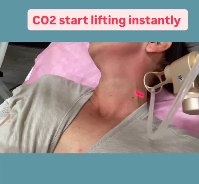 CO, treatments can show surprisingly fast results, especially when it comes to skin tightening and lifting effects on areas like the neck.#capricebeautybar #theskingames2024 #age #sarasotaflorida #tampabay #sarasota #skin #co2laser #co2 #skin resurfacing #lolahodges #siberianbeautyskin