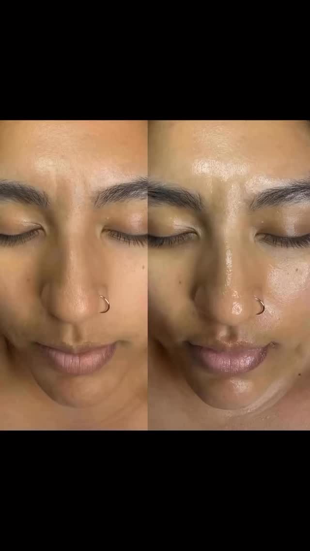 #Dermaplane facial #whodis #picture is picture doesn’t justify how it looked in person #brighteningskin #newface #softskin #thatglowthough