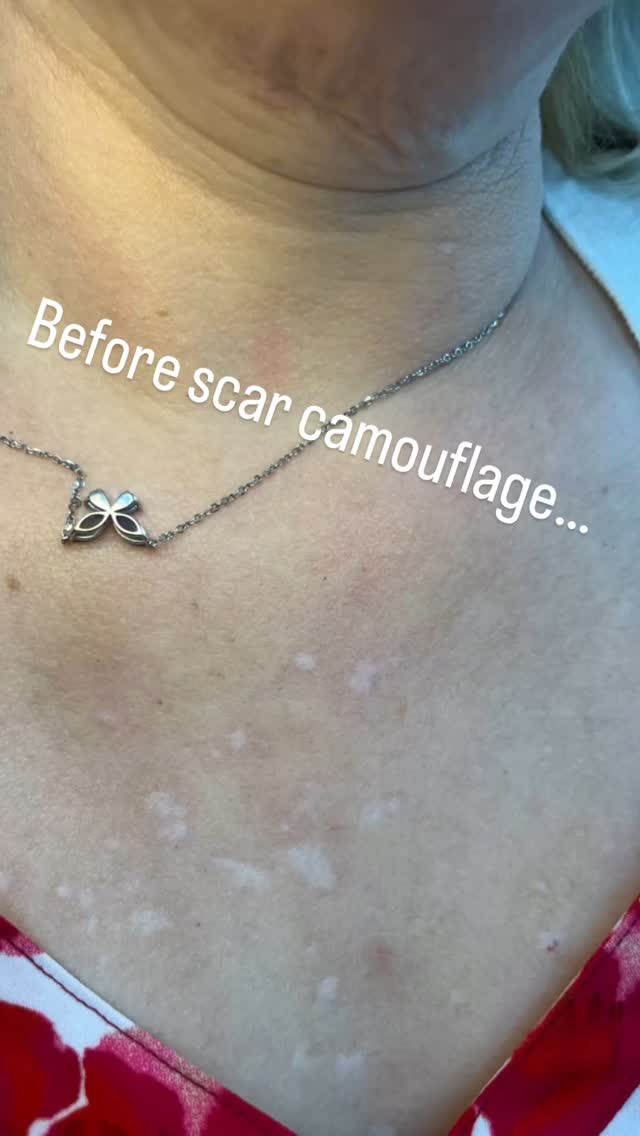 You don’t have to live with scars. I can help! scarcamouflagetattoo #scarcamouflage #lasvegas #hollyjoypmu