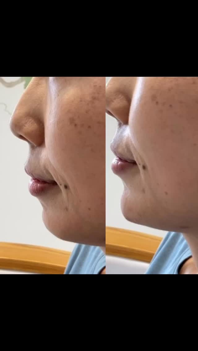 ✨ Side profile goals, achieved! 💉💕
Using RHA 4 by Teosyal, we enhanced the chin and balanced the lower face while maintaining the natural Pyramid of Beauty—creating a youthful, harmonious look from every angle.
This dynamic filler adapts beautifully with facial movement, offering structure without stiffness. Think: refreshed, defined, and oh-so-natural. 💫
📸 Do you see the transformation and how a subtly sculpted chin can elevate the entire profile?
💬 Curious if this could work for you? DM us to book your consultation today.
#FacialBalancing #RHA4 #TeosyalFiller #ChinFiller #ProfileGoals #PyramidOfBeauty #NaturalResults #DermalFillerBeforeAndAfter #YouthfulGlow #SubtleEnhancement #AestheticMedicine