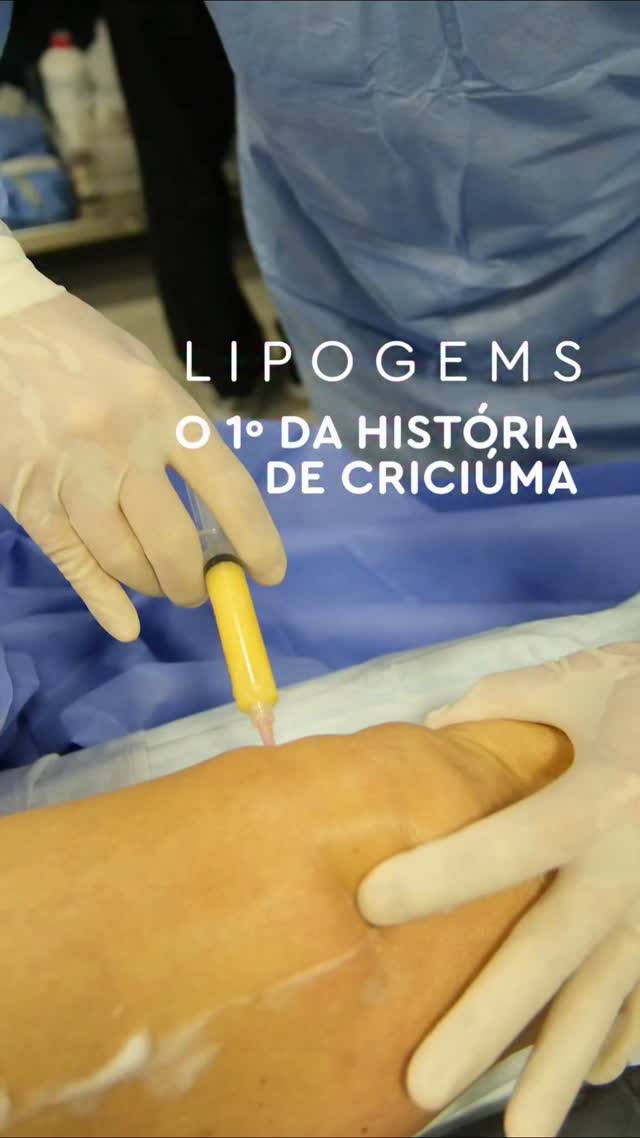 O primeiro da história de Criciúma.
Lipogems é um procedimento de ponta a nível mundial que consiste na retirada de gordura do corpo do paciente, principalmente do abdômen, para que depois de tratada, a gordura seja aplicada através de uma infiltração no joelho, com ação importante de células tronco que contribuem para a regeneração.
Um procedimento que já havíamos feito em outros lugares, mas agora pela primeira vez na Capital do Carvão, nas instalações do Alta Villa Hospital Dia.
O Lipogems é mais ação pioneira em que a equipe do Joelho no Esporte está envolvida, o que para nós é um motivo de grande orgulho.
Acompanhe...