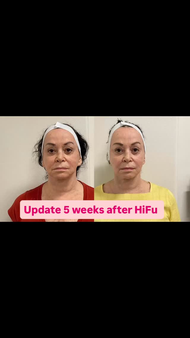 #capricebeautybar #age #theskingames2024 #tampabay #sarasotaflorida #sarasota #medspa #skin #age #nyc #hifu #hifufacelifting #beauty #lift