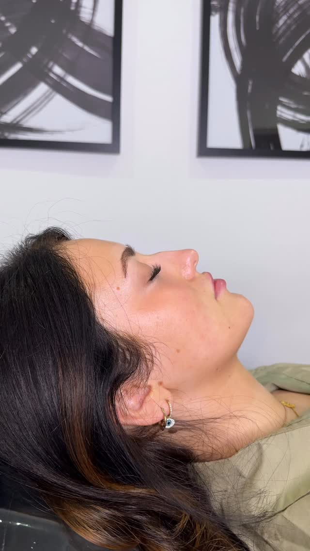 When your client requests the nose of her dreams and you definitely deliver 😮💨
It honestly is the most rewarding job seeing how much one treatment can change a persons life! Jodie left our clinic with a new found confidence after our liquid rhinoplasty treatment! 🥹❤️