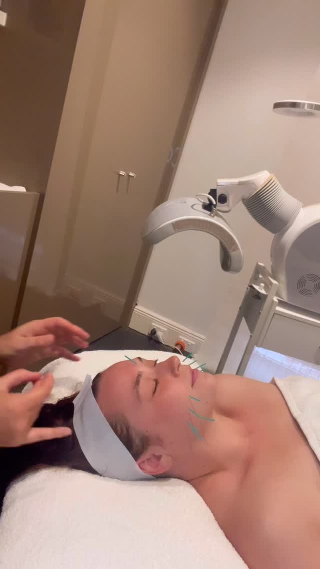 Are you missing the real link to clearing your skin?
It’s not about round after round of chemical peels, Roaccutane, the pill, doxycycline or spironolactone.
It’s about addressing the real root of your acne: internal heat, hormone imbalance, poor detoxification, a dysregulated nervous system, and a compromised gut-skin axis.
If you’ve tried everything and nothing’s worked, it’s time to try something different.
✨ Ready to do the internal work and truly heal your skin? DM me or book via the link in bio.
#cosmeticacupuncture #holisticskinhealing #acnejourney #acneclinic #acnetreatment #gutskinconnection #hormonalacne #skinbarrierrepair #acupunctureforacne #skinfromwithin #acnehealing #naturalacnetreatment #internalhealing #clearacneskin #naturopathicskin