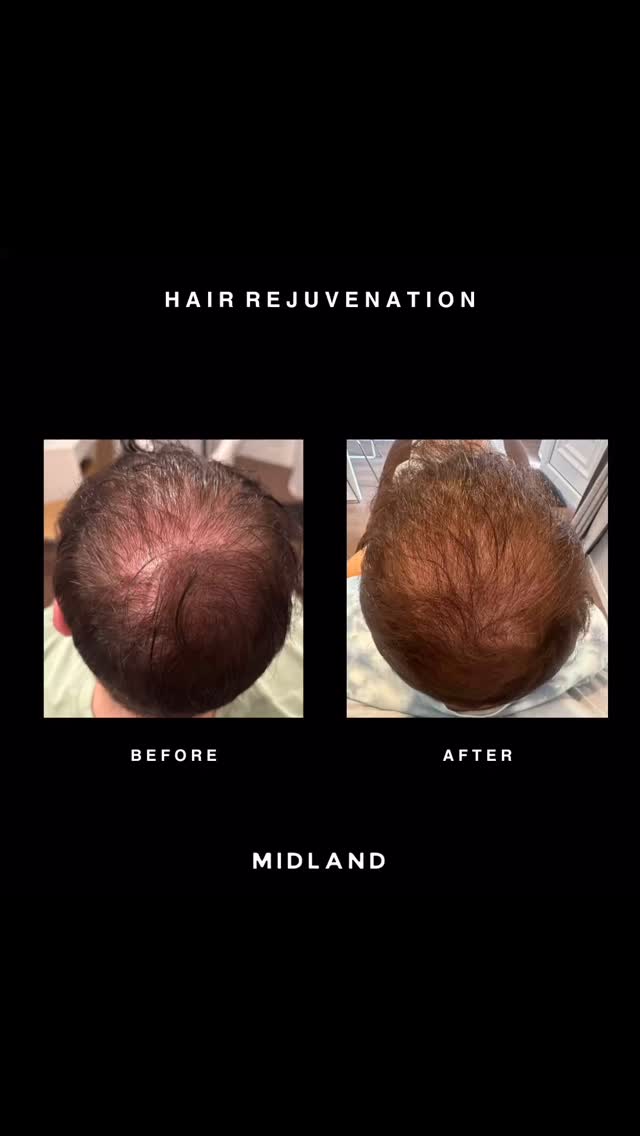 ✨ PRP for Hair Rejuvenation – Real Results! ✨
See the transformation after just 2 sessions! 💉💫
PRP (Platelet-Rich Plasma) is a natural and powerful solution for hair restoration — using your own blood to awaken your scalp at a cellular level.
🩸 The golden growth factors in PRP are injected directly into the hair follicles, stimulating the dermal papilla, reducing hair loss, boosting growth, and improving overall hair quality.
🔁 A series of 3 sessions spaced 4–6 weeks apart is typically recommended for optimal, long-lasting results.
𝖡𝗈𝗈𝗄𝗂𝗇𝗀𝗌
☏ 𝟢𝟩𝟦𝟫𝟪𝟫𝟪𝟩𝟣𝟪𝟪
☞︎ 𝗆𝗂𝖽𝗅𝖺𝗇𝖽𝖼𝗅𝗂𝗇𝗂𝖼𝗌@𝗀𝗆𝖺𝗂𝗅.𝖼𝗈𝗆
✩ 𝗐𝗐𝗐.𝗆𝗂𝖽𝗅𝖺𝗇𝖽𝖼𝗅𝗂𝗇𝗂𝖼.𝖼𝗈.𝗎𝗄
𝖬𝗂𝖽𝗅𝖺𝗇𝖽 𝖠𝖾𝗌𝗍𝗁𝖾𝗍𝗂𝖼𝗌 𝖢𝗅𝗂𝗇𝗂𝖼 𝖢𝗈𝗏𝖾𝗇𝗍𝗍𝗒
✩ 𝖬𝖾𝖽𝗂𝖼𝖺𝗅 𝖯𝗋𝖺𝖼𝗍𝗂𝗍𝗂𝗈𝗇𝖾𝗋 𝖫𝖾𝖽 𝖠𝖾𝗌𝗍𝗁𝖾𝗍𝗂𝖼𝗌
✩ 𝖥𝗎𝗅𝗅𝗒 𝖨𝗇𝗌𝗎𝗋𝖾𝖽 𝖢𝗈𝗌𝗆𝖾𝗍𝗂𝖼 𝖢𝗅𝗂𝗇𝗂𝖼
✩ 𝖯𝗋𝗂𝗏𝖺𝗍𝖾 𝖺𝗇𝖽 𝖢𝗈𝗇𝖿𝗂𝖽𝖾𝗇𝗍𝗂𝖺𝗅
#PRPHairTreatment #HairRejuvenation #HairLossSolution #BeforeAndAfter #NaturalHairGrowth #PlateletRichPlasma #HairRestoration #ScalpHealth