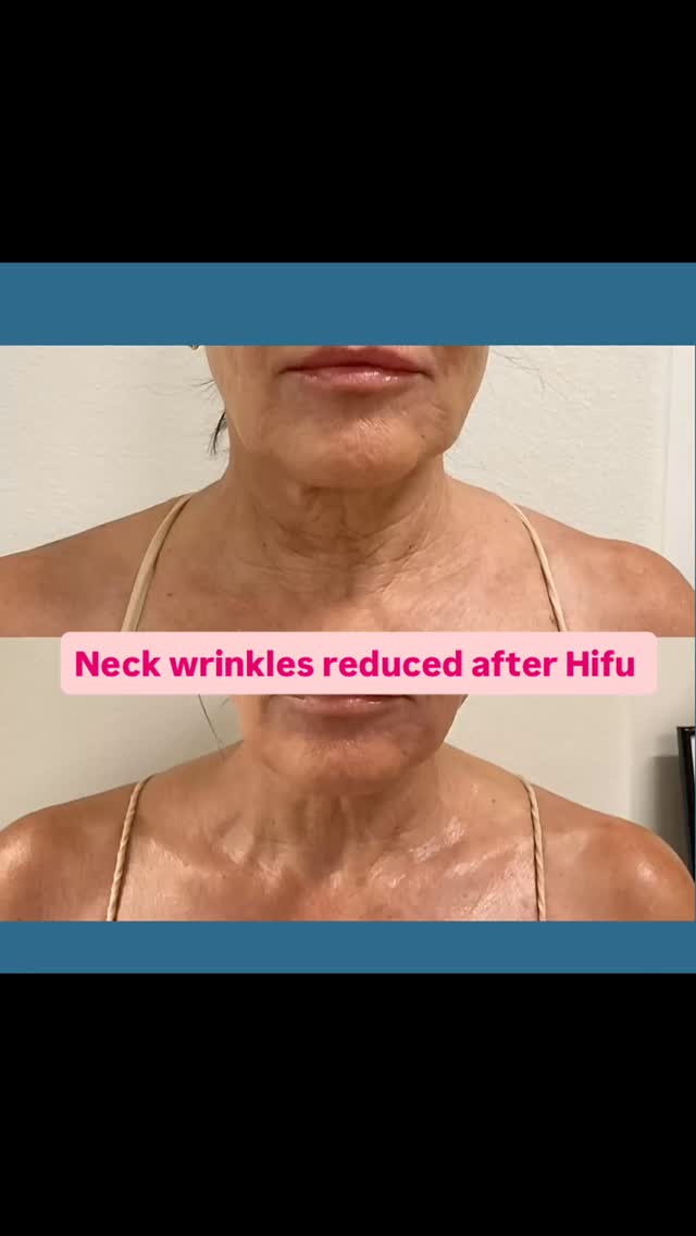 #capricebeautybar #theskingames2024 #age #tampabay #sarasotaflorida #medspa #sarasota #skin #spa #hifu #hifufacelifting #siestakeybeach #siestaflorida #necklift #wrinkles