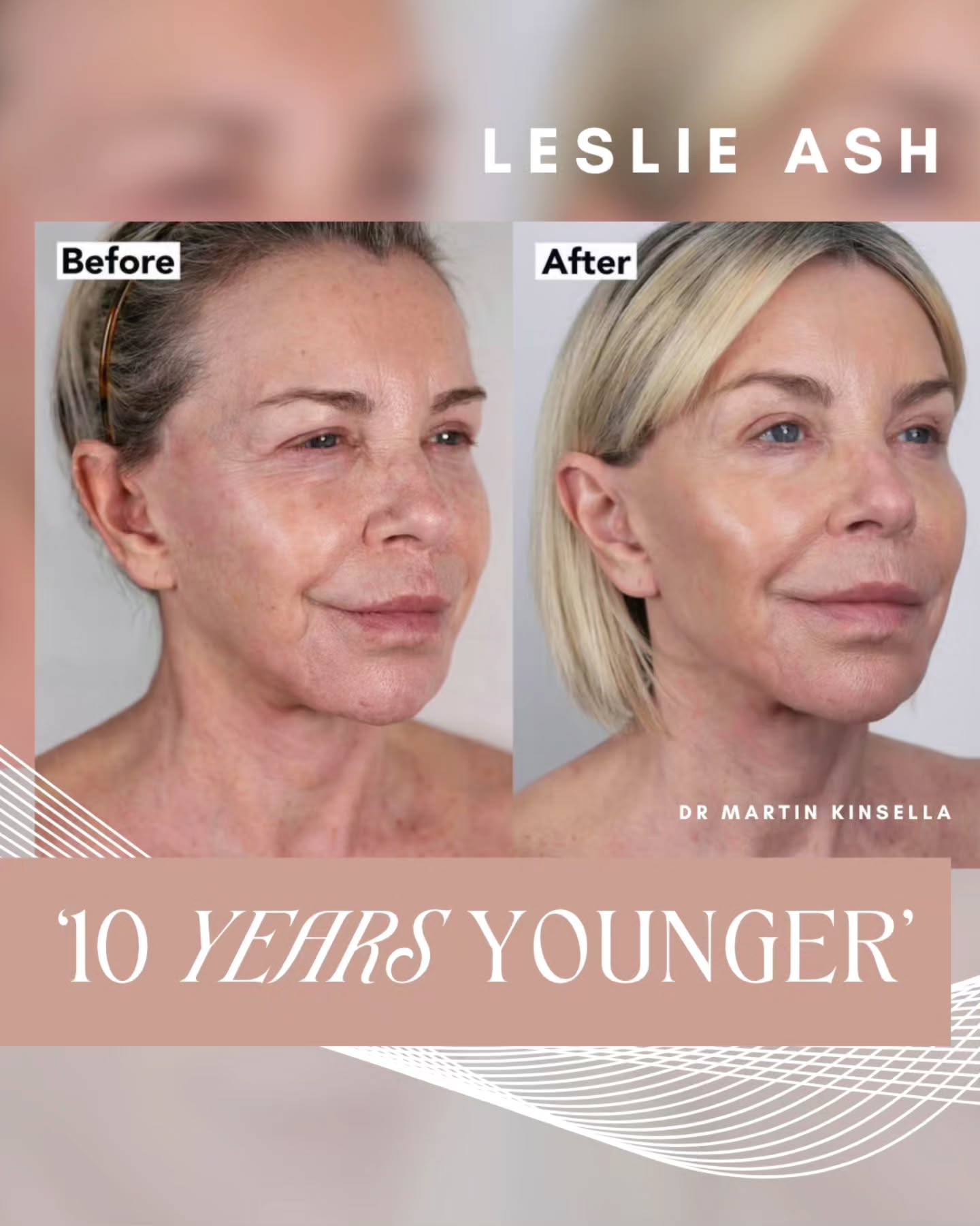 ✨ “It’s taken 10 years off me.” – Leslie Ash ✨
Over the past few months, actress and TV presenter @leslieash_ has seen an incredible skin transformation thanks to NeoGen nitrogen plasma treatments @neogenplasma_official with @drmartinkinsella
Tighter skin around the eyes, a more defined jawline, and a radiant glow—the results speak for themselves.
We’re thrilled to offer this advanced, non-surgical treatment here at The Courtyard.
📆 Book your FREE skin consultation today and discover what NeoGen can do for you.
•
•
•
#SkinConfidence #NeoGenPlasma #SkinRejuvenation #NaturalResults #CourtyardClinic #HealthySkin #GlowUp #NonSurgicalLift