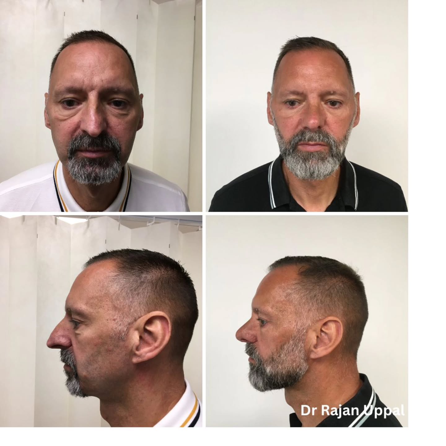It was great to see this patient one year after Rhinoplasty. He is really happy with the results of surgery to make his nose smaller and to help with his breathing.
In men the skin is slightly thicker than in women and the aspirations can be different in some cases. This is why we design the nose before the surgery on the computer so we can really support you and give you a tailor-made outcome that you are happy with.
#beforeandafter #beforeandafternose #nose #nosejobbeforeandafter #rhinoplasty