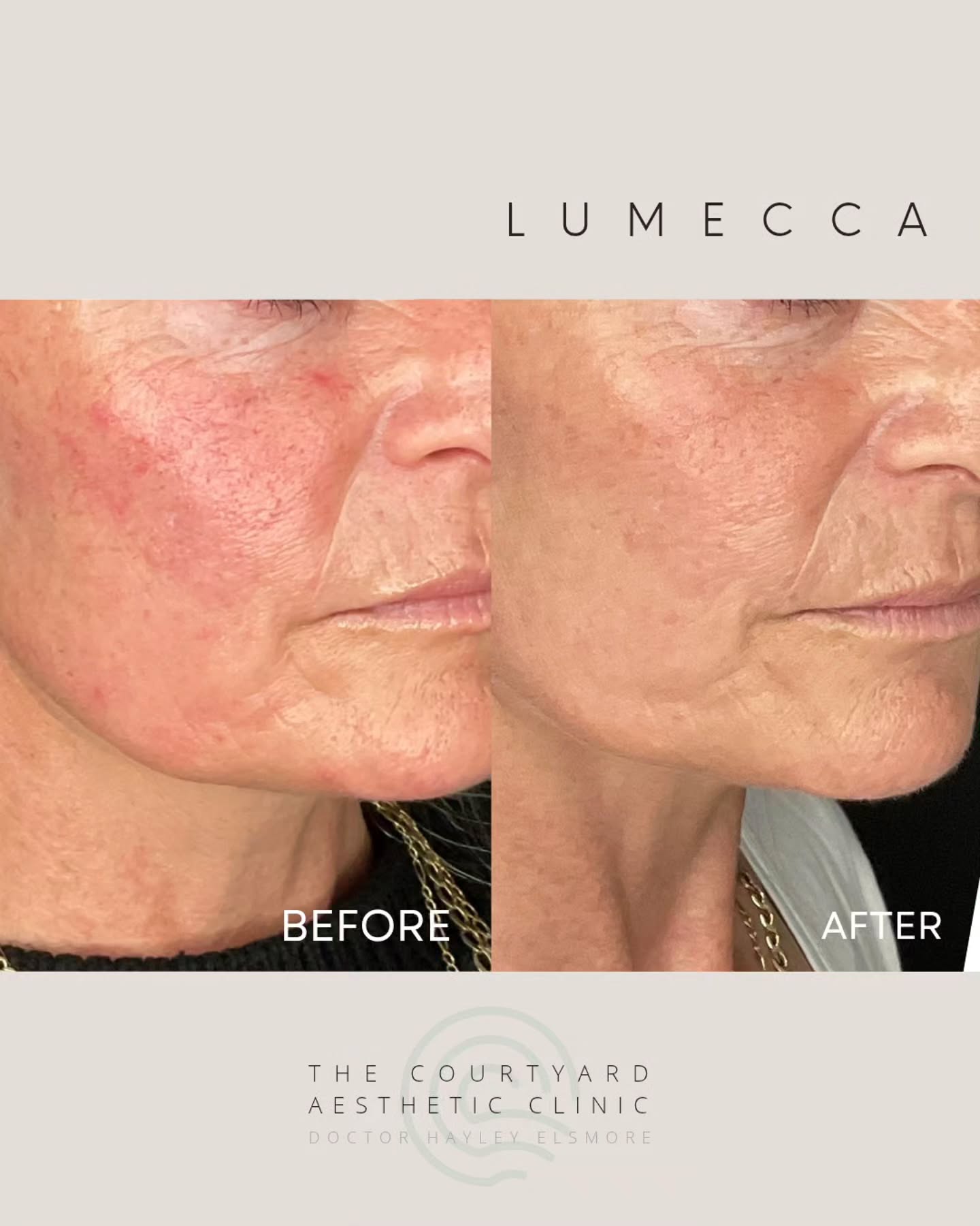 Even subtle enhancements can lead to a significant boost in skin confidence ✨️
Achieving a clearer, more even complexion can make all the difference in how you feel day to day.
This client presented with rosacea and mild age-related pigmentation. Following two treatments of Lumecca, there is a visible reduction in redness and improved overall skin tone and clarity 😍
Lumecca is a highly effective IPL treatment designed to target vascular lesions, pigmentation, and uneven skin texture—delivering impressive results with minimal downtime.
Real results. Real confidence.
Book your FREE skin consultation TODAY!
•
•
•
#lumecca #ipl #rosacea #pigmentation #ipltreatment #laser #skinclarity #skinconfidence #aesthetictreatment #skindoctor #confidenceboost #feelgood #lumeccainmode #lumeccaipl