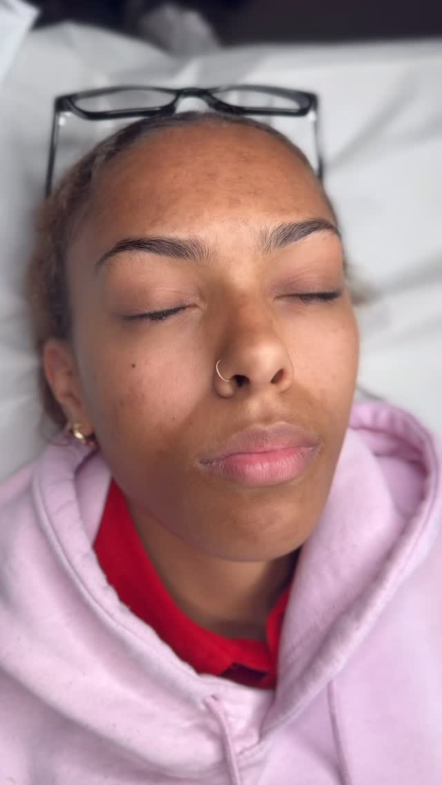 โจ 0.7ml Lip Enhancement ๐โจ
Sometimes itโs the subtle tweaks that make the biggest difference! This beauty already had gorgeous lips โ we simply refined her shape, added soft definition, and a touch of volume for that perfect plump ๐
๐ Natural. Balanced. Effortless. ๐
Ready to enhance your lips? DM to book your dream lips today โ appointments are filling fast!
#LipGoals #NaturalLips #LipEnhancement #LipFillerUK #SubtleLips #PlumpLips #LipTransformation #FillerDoneRight #BeautyEnhancement #GlowUp #foryou #fyp