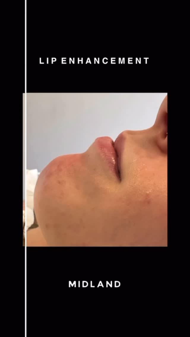 ✨ Lip Filler Glow-Up ✨
Absolutely loving this subtle enhancement on our beautiful client 💋
We used just 0.8mL of flexible-density filler to:
💉 Add side-profile projection
💉 Gently lengthen the lips
💉 Maintain and respect her natural shape
A perfect example of enhancing, not overpowering 🙌
#LipFiller #SubtleEnhancement #NaturalResults #ProfileBalancing #Aesthetics #BeforeAndAfter #DermalFiller #LipGoals
𝖡𝗈𝗈𝗄𝗂𝗇𝗀𝗌
☏ 𝟢𝟩𝟦𝟫𝟪𝟫𝟪𝟩𝟣𝟪𝟪
☞︎ 𝗆𝗂𝖽𝗅𝖺𝗇𝖽𝖼𝗅𝗂𝗇𝗂𝖼𝗌@𝗀𝗆𝖺𝗂𝗅.𝖼𝗈𝗆
✩ 𝗐𝗐𝗐.𝗆𝗂𝖽𝗅𝖺𝗇𝖽𝖼𝗅𝗂𝗇𝗂𝖼.𝖼𝗈.𝗎𝗄
𝖬𝗂𝖽𝗅𝖺𝗇𝖽 𝖠𝖾𝗌𝗍𝗁𝖾𝗍𝗂𝖼𝗌 𝖢𝗅𝗂𝗇𝗂𝖼 𝖢𝗈𝗏𝖾𝗇𝗍𝗍𝗒
✩ 𝖬𝖾𝖽𝗂𝖼𝖺𝗅 𝖯𝗋𝖺𝖼𝗍𝗂𝗍𝗂𝗈𝗇𝖾𝗋 𝖫𝖾𝖽 𝖠𝖾𝗌𝗍𝗁𝖾𝗍𝗂𝖼𝗌
✩ 𝖥𝗎𝗅𝗅𝗒 𝖨𝗇𝗌𝗎𝗋𝖾𝖽 𝖢𝗈𝗌𝗆𝖾𝗍𝗂𝖼 𝖢𝗅𝗂𝗇𝗂𝖼
✩ 𝖯𝗋𝗂𝗏𝖺𝗍𝖾 𝖺𝗇𝖽 𝖢𝗈𝗇𝖿𝗂𝖽𝖾𝗇𝗍𝗂𝖺𝗅