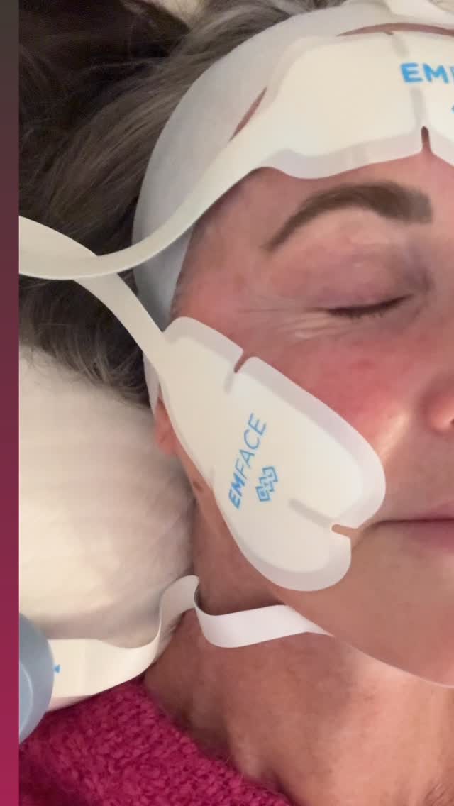 Cheeks on fleek!
Watch as Emface works its magic, lifting and toning those cheeky muscles for a natural glow-up. Who knew self-care could be this fun!
💛
#cheeklift #OgeeFacialRejuvenation
#cosmetictreatments #skinrejuvenation #facialenhancement #NonSurgical #Emface #emfacetreatment #noninvasivetreatment #noninvasivefacelift #collagenboost #skincliniccanberra
#canberrabeauty #cosmetictreatments #antiaging