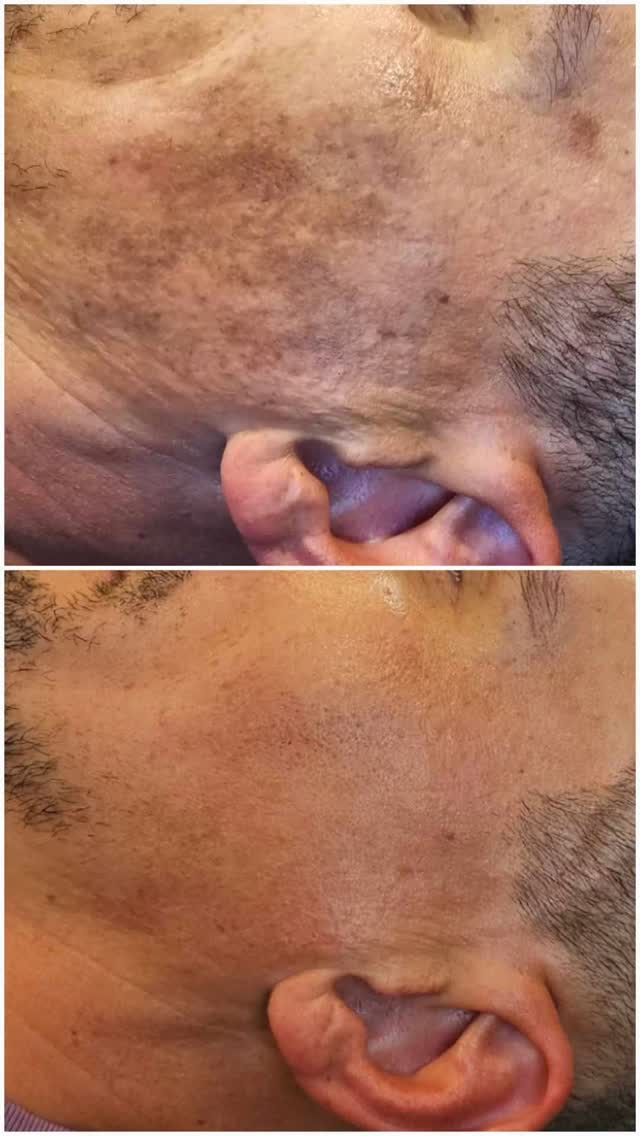 Overtreatment with IPL lead to this PIHP.
I love IPL but this was operator error NOT the machine!
Immediately we started treatment with yellow light therapy and this was done every day using red and yellow, rejuvenation mode.
Combined with @lira homecare and customized peels we have achieved this result👌
@thepowderroom_by_ginene
#ledlights #ledtreatment #pigmentation #ipl2025 #redlight #nzbusiness