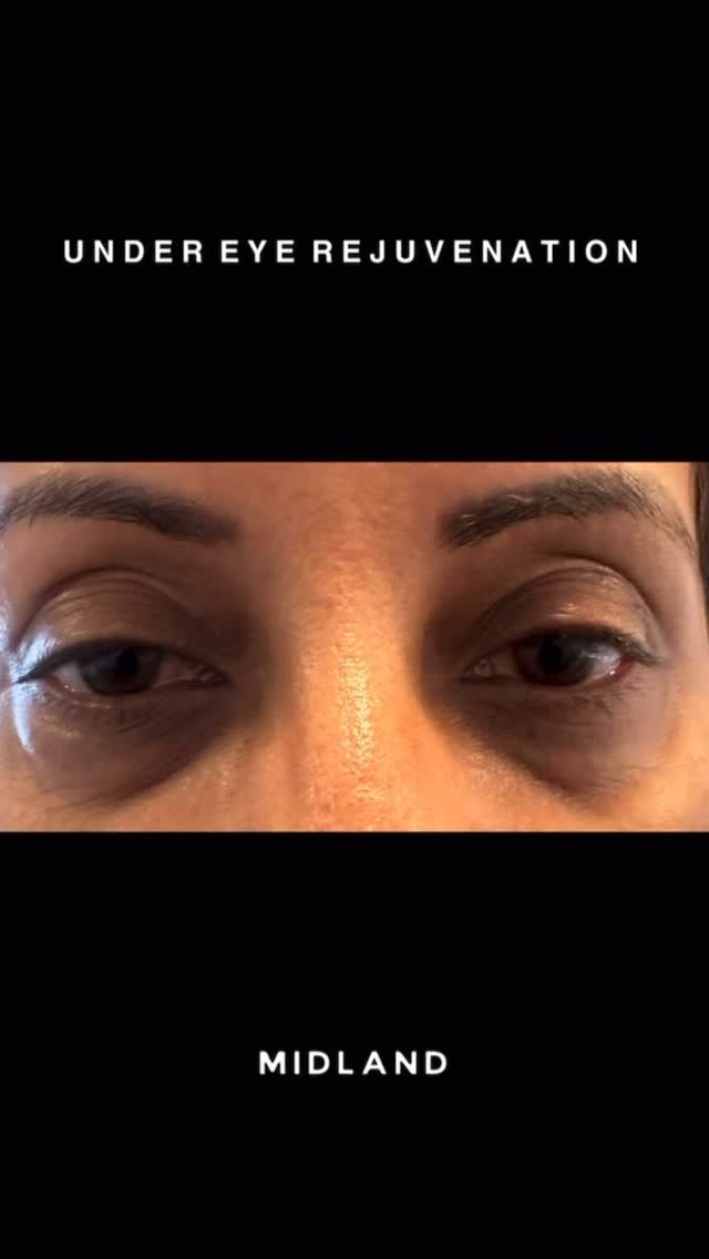 Tired of looking tired?
Here’s a stunning example of under-eye rejuvenation using Teoxane Redensity II, a specialist dermal filler formulated specifically for the delicate periorbital area 👁️✨
This treatment helps to:
✔️ Soften the appearance of eye bags
✔️ Brighten dark circles caused by volume loss & shadowing
✔️ Restore a smoother transition from the lower eyelid to the cheek
📍 In this case, we didn’t just treat the tear trough directly. A small amount of product was carefully placed just outside the tear trough and into the malar region to support the midface and reduce hollowness. This indirect approach enhances the results while preserving a natural look.
💉 Product: Teoxane Redensity II – known for its lightweight consistency and added antioxidants for tissue quality
🕒 Treatment Time: ~30 minutes
🔪 Cannula technique used for safety and minimal downtime
⏳ Results last 6–12+ months (depending on individual metabolism and lifestyle)
💧 Post-treatment: mild swelling or bruising may occur, but most clients return to daily activities immediately
𝖡𝗈𝗈𝗄𝗂𝗇𝗀𝗌
☏ 𝟢𝟩𝟦𝟫𝟪𝟫𝟪𝟩𝟣𝟪𝟪
☞︎ 𝗆𝗂𝖽𝗅𝖺𝗇𝖽𝖼𝗅𝗂𝗇𝗂𝖼𝗌@𝗀𝗆𝖺𝗂𝗅.𝖼𝗈𝗆
✩ 𝗐𝗐𝗐.𝗆𝗂𝖽𝗅𝖺𝗇𝖽𝖼𝗅𝗂𝗇𝗂𝖼.𝖼𝗈.𝗎𝗄
𝖬𝗂𝖽𝗅𝖺𝗇𝖽 𝖠𝖾𝗌𝗍𝗁𝖾𝗍𝗂𝖼𝗌 𝖢𝗅𝗂𝗇𝗂𝖼 𝖢𝗈𝗏𝖾𝗇𝗍𝗍𝗒
✩ 𝖬𝖾𝖽𝗂𝖼𝖺𝗅 𝖯𝗋𝖺𝖼𝗍𝗂𝗍𝗂𝗈𝗇𝖾𝗋 𝖫𝖾𝖽 𝖠𝖾𝗌𝗍𝗁𝖾𝗍𝗂𝖼𝗌
✩ 𝖥𝗎𝗅𝗅𝗒 𝖨𝗇𝗌𝗎𝗋𝖾𝖽 𝖢𝗈𝗌𝗆𝖾𝗍𝗂𝖼 𝖢𝗅𝗂𝗇𝗂𝖼
✩ 𝖯𝗋𝗂𝗏𝖺𝗍𝖾 𝖺𝗇𝖽 𝖢𝗈𝗇𝖿𝗂𝖽𝖾𝗇𝗍𝗂𝖺𝗅
#TearTroughFiller #UnderEyeRejuvenation #TeoxaneRedensityII #DermalFillerExpert #MalarSupport #EyeBagTreatment #DarkCircles #CannulaTechnique #AestheticMedicine #AdvancedInjectables #NaturalResults #SkinBrightening #FacialBalancing #SubtleEnhancement #GlowUp #MidfaceRejuvenation