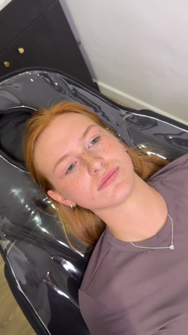 HELLO FIRST TIME FILLER 🥹
Had the gorgeous Lauren in clinic today getting her Ibiza ready 😍 we focused on shape, hydration and giving that subtle plump which you are all loving this summer ❤️
Of course we used 0.8ml of RHA2 by @teoxane_uk for this transformation