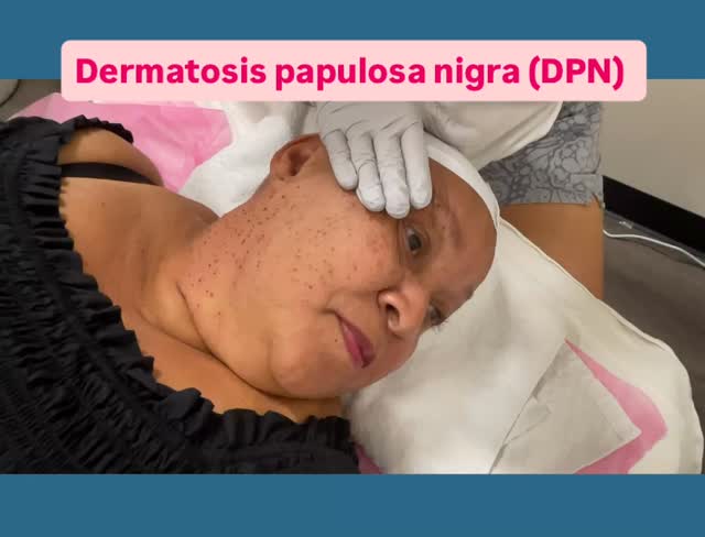 Update ‼️cleaner,tag free face #capricebeautybar #theskingames2024 #age #tampabay #sarasotaflorida #sarasota #nyc #skin #hifu #dpn #siestakeybeach #siestakeyfl