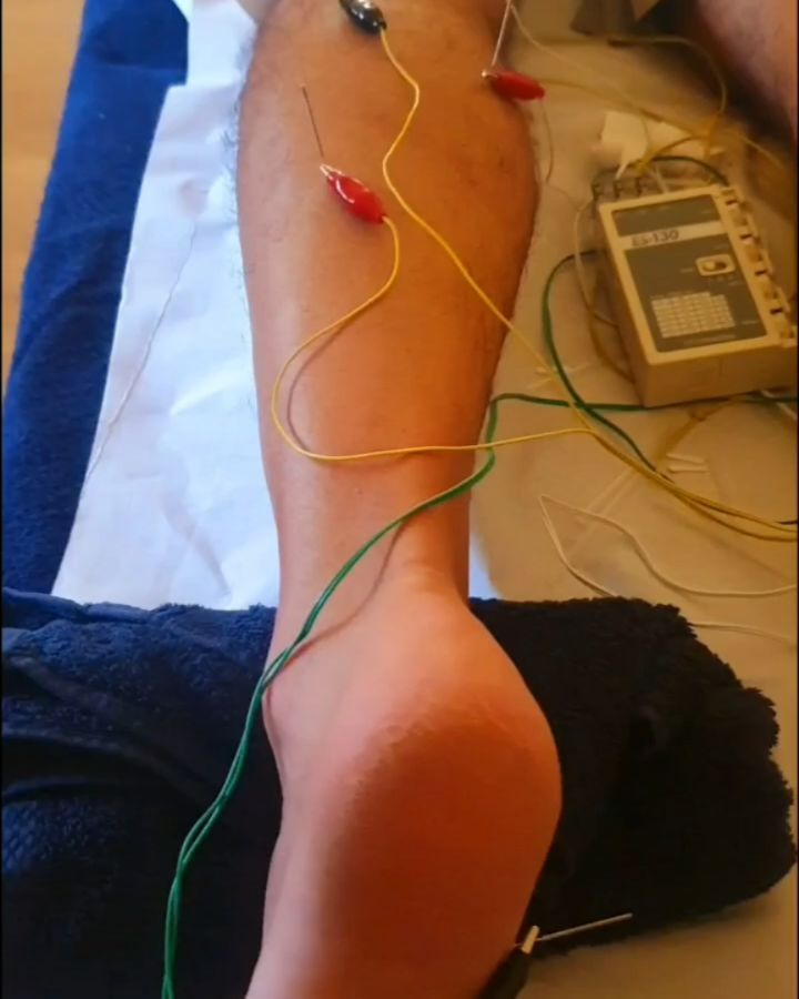 Hoy aprovechamos para compartir una parte del trabajo realizado para tratar una fascitis plantar en un paciente.
En el video observamos un abordaje con neuromodulación de el nervio CPI, tríceps sural y flexor del hallux.
Mediante esta técnica aconseguiremos:
✅Disminuir la sensación de tensión muscular
✅Disminuir el dolor
✅Restablecer el funcionamiento "normal" del sistema nervioso
⚠️Este trabajo es complementario a un manejo activo de la patología mediante una propuesta de ejercicios y ajustes en la progresión de los mismos⚠️
#fisiodosrius #fisioinvasiva #fisioterapia #dolor #neuromodulacion #neuropatia #fascitisplantar #gemelos #neurologia #tratamiento #rehabilitación #trabajodefuerza #readaptación