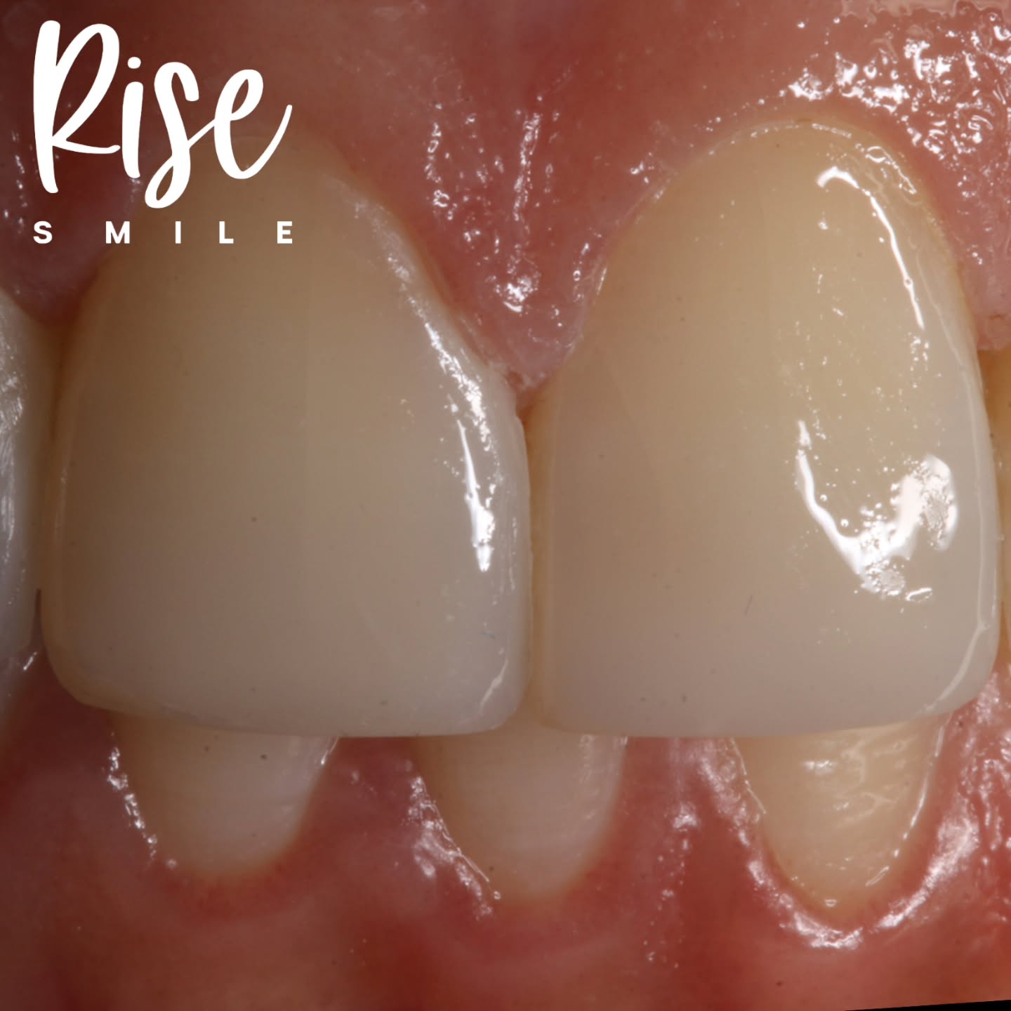 Reconstrucción dentaria de bordes fracturados y desgastados con resina compuesta de alta estética.
Quieres una hora de evaluación? Envíanos un mensaje