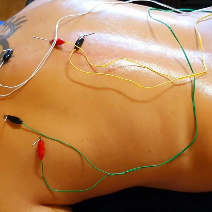 Abordaje de neuromodulación invasiva a un paciente con dolor torácico de larga duración que se irradia hacia la parte anterior del torax, siguiendo la trayectoria de una costilla.
📝 Nos explica que ese dolor es como un quemazón intenso muy molesto, a parte de la sensación de pinchazo repentino al realizar algún gesto determinado.
El paciente también sufre constantemente dolor anterior de hombro y problemas en las cervicales.
En este caso nos decantamos por tratar a nivel de infraespinoso, nervio espinal torácico y cervical.
En 3️⃣ sesiones hemos conseguido:
✅ Eliminar esa sensación de quemazón
✅ Eliminar el dolor tipo pinchazo
Esta tansolo es una parte del tratamiento realizado con este paciente.
Si sufres de dolor persistente y no sabes ya qué hacer para solucionar tu problema, no dudes en preguntarme y descubrir de que forma puedo ayudarte 📥
#fisioterapia #dolor #torácico #cervicales #hombro #nervio #rehabilitación #neuromodulacion #fisioterapiainvasiva #soluciones #recuperacion #readaptacion #dosrius #canmassuet #canyamars #mataro #llinarsdelvalles