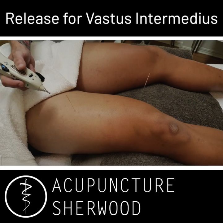 #acupuncture #acupuncturelife #acupuncturedoctor #ancientmedicine #acupunctureneedles #acupunctureworks #acupuncturerocks #acupuncturist #acupuncturebrisbane #knee #kneepain #vastusintermedius