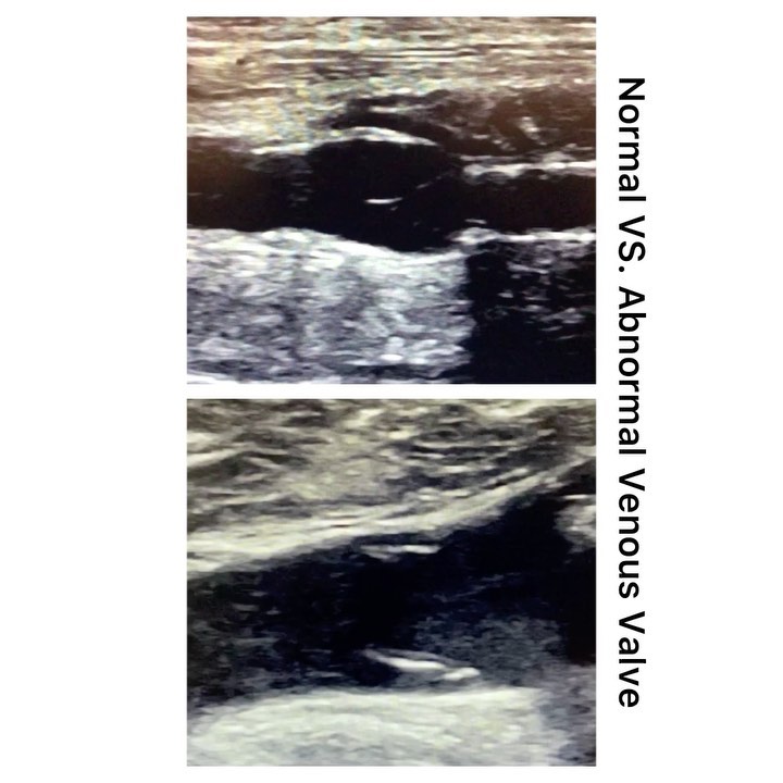 Normal vs. Abnormal Venous Valve. Can you spot the difference? 🧐🤓
.
.
.
.
#ultrasound #sonography #medicalsonography #RDMS #RVT #RegisteredDiagnosticMedicalSonographer #RegisteredVascularTechnologist #UltrasoundTechnologist #Sonographer #UltrasoundTech #Sonography101 #ultrasoundED #ultrasononography #ultrasonographer #Medicine #Medical #Radiology #Radiologia #Ultrasonido #DiagnosticImaging #Medicina #Sonograma
#sonographystudent #sonographyschool