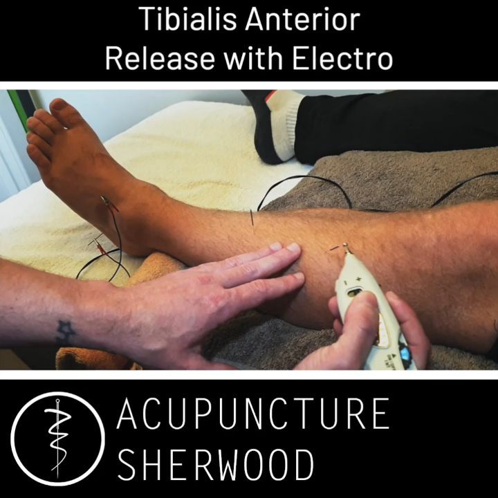 #acupuncture #acupuncturelife #acupuncturedoctor #acupunctureworks #acupunctureneedles #acupuncturerocks #acupuncturist #acupuncturebrisbane #legpain #legpaintreatment #electroacupuntura #electroacupunture #tibialisanterior