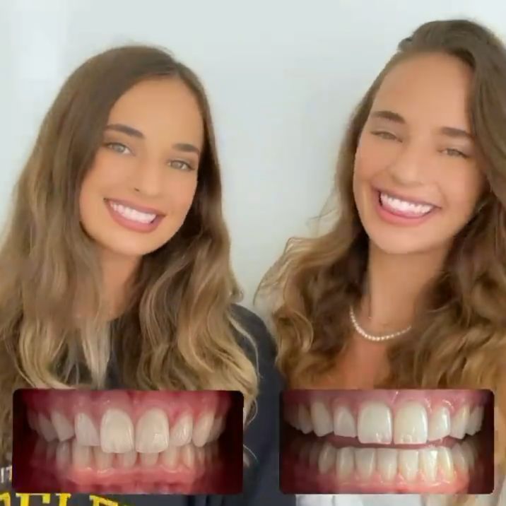 Klinik Tandblekning 
ERBJUDANDE 1490 KR (Ordinarie pris 4900 kr)
ONLINE TIDSBOKNING
www.DentalClinicSweden.org 🔺️ BOKA FÖR 2 PERSONER & FÅ YTTLIGARE 200 KR RABATT!
 #tandblekningstockholm #TandblekningStockholm #KlinikTandblekning #TandblekningGöteborg #TandblekningUppsala #TandblekningUtbildning #TandblekningsUtbildning