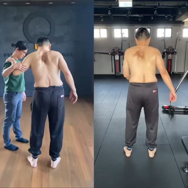 Amazing work by fp Taiwan !
#Repost @fp.taiwan
• • • • • •
FP 人體力學專家 @chun_yi_hsiao 驚人成果。
客戶在多年前做了手術將胸椎部位的巨大腫瘤移除,然而這造成後續的腰椎的問題:
腰椎退化、滑脫、狹窄,進而又做了三場腰椎手術。
後來又因爲脊髓病變、上運動神經元受損,行動能力也開始喪失(如影片左)長達五年。😥 經過20堂課 FP訓練(約四個月),可以看到我們的訓練成果!他的行走能力獲得很大的進步-走更快、更遠。
FP適合所有人!
-
Client under went a surgery on thoracic spine to remove a tumor and unfortunately this surgery leads to Spondylolisthesis and Lumbar spine stenosis which result in three more operation.
After these surgery the tumor still infect his spine which leads to spine cord disease and hurt his upper motor neuron causing walking dysfunction.(Left)
He took 20 FP training sessions(about 4 months), now here is the result - walk faster and further.
FP is for everyone.
-
🔘一對一訓練
🔘六週團體課
🔘免費體驗一對一私教課程
#台北信義店三月底試營運
www.fptaiwan.com.tw 🔘Human Foundation Course 研習課程
www.functionalpatterns.com
#fpisthestandard #functionalpatterns #健身新文化 #運動 #跑步 #健身